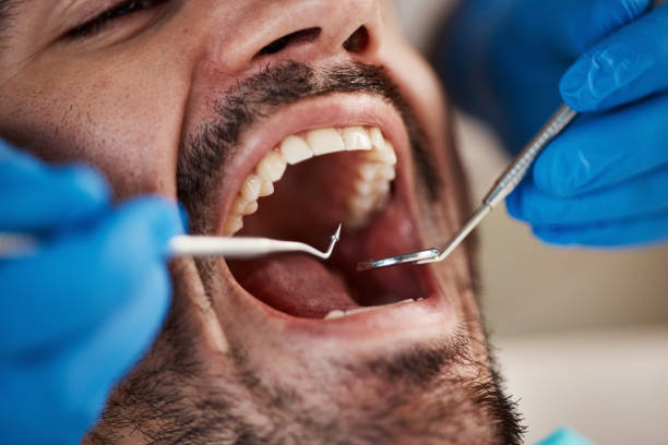 Best Dentist for Tooth Abscess  in Mora, MN